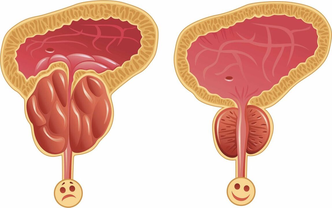 Простата пред и по третманот со капсули Prostaffect