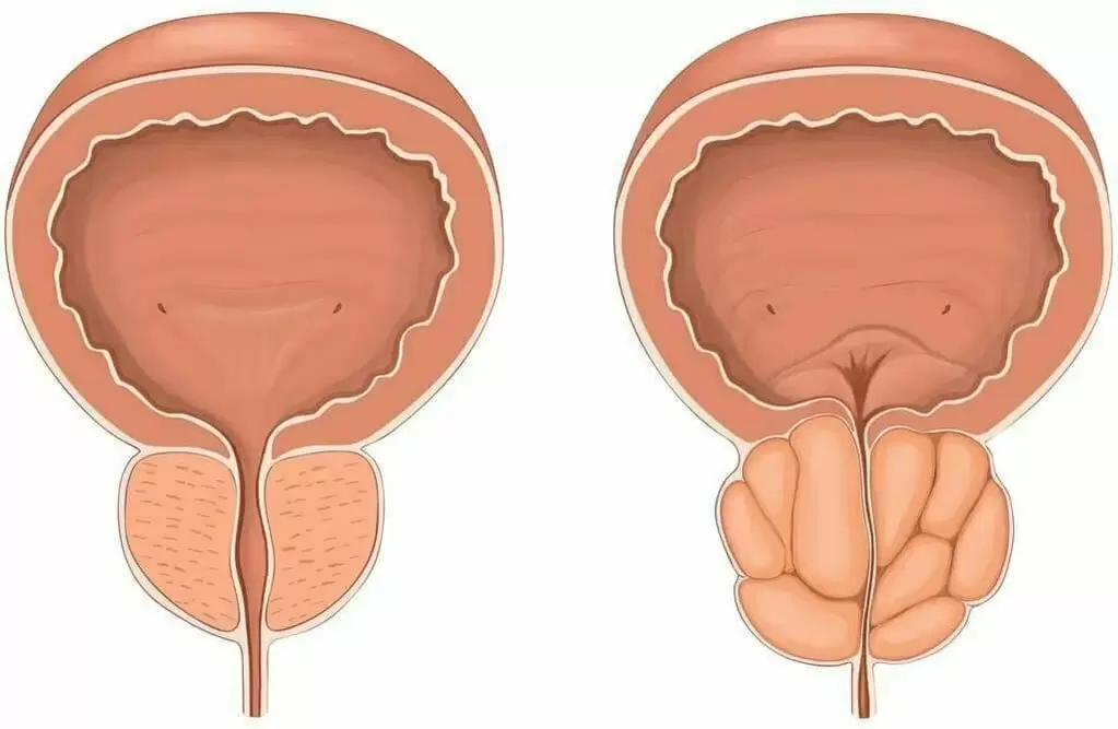 нормална простата и заболена простата