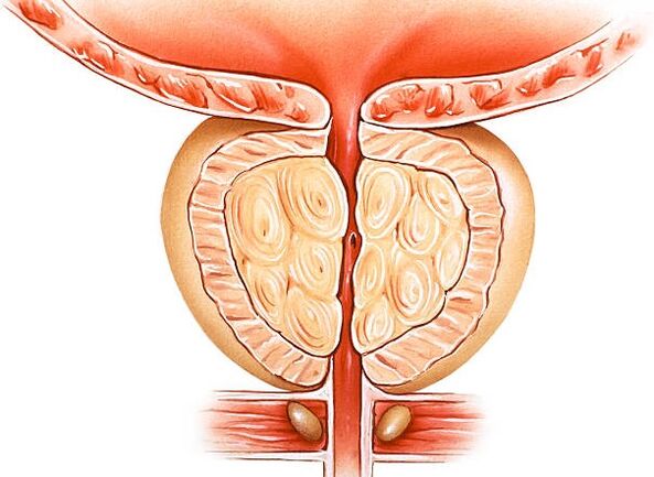 воспалена илустрација на простатата