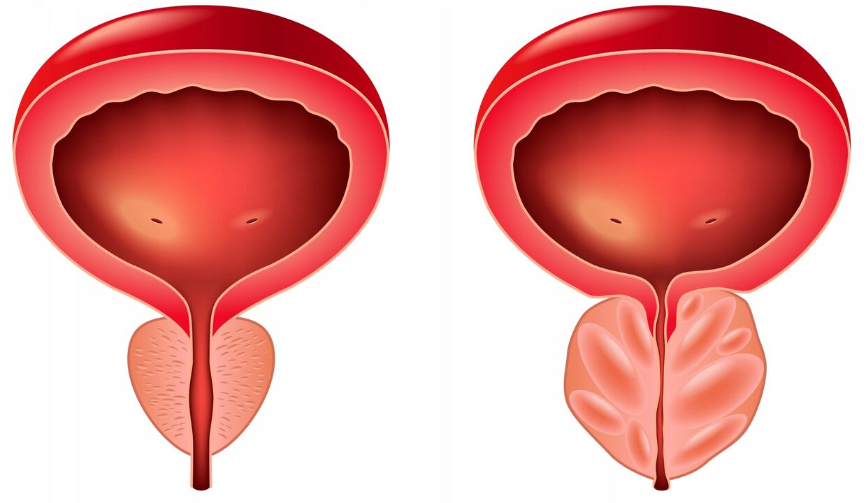 разлика помеѓу жлездите на простатата